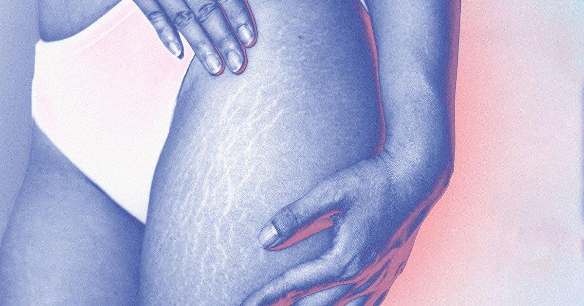 Как принять свою кожу: растяжки, шрамы и воспаления